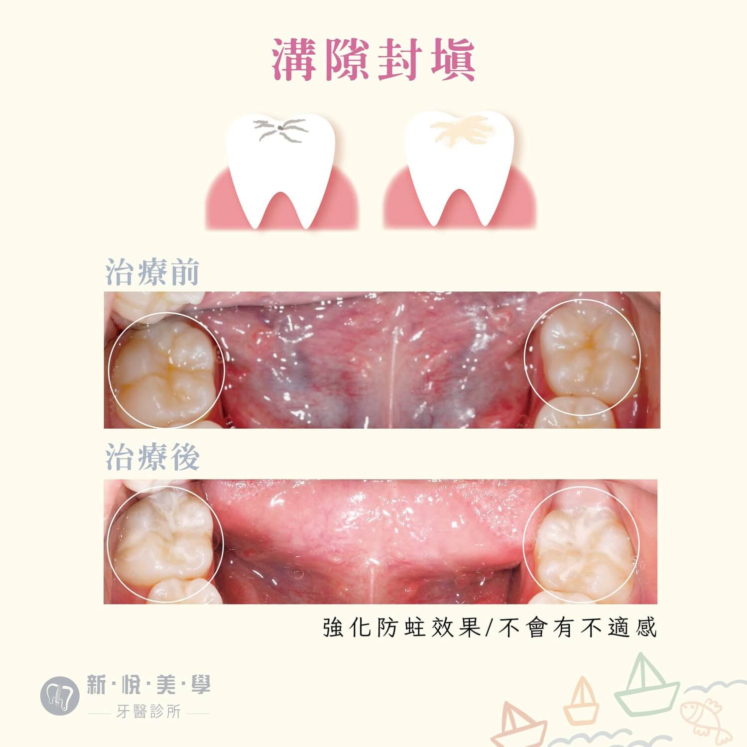 我們家寶貝有蛀牙怎麼辦?的第2張圖片